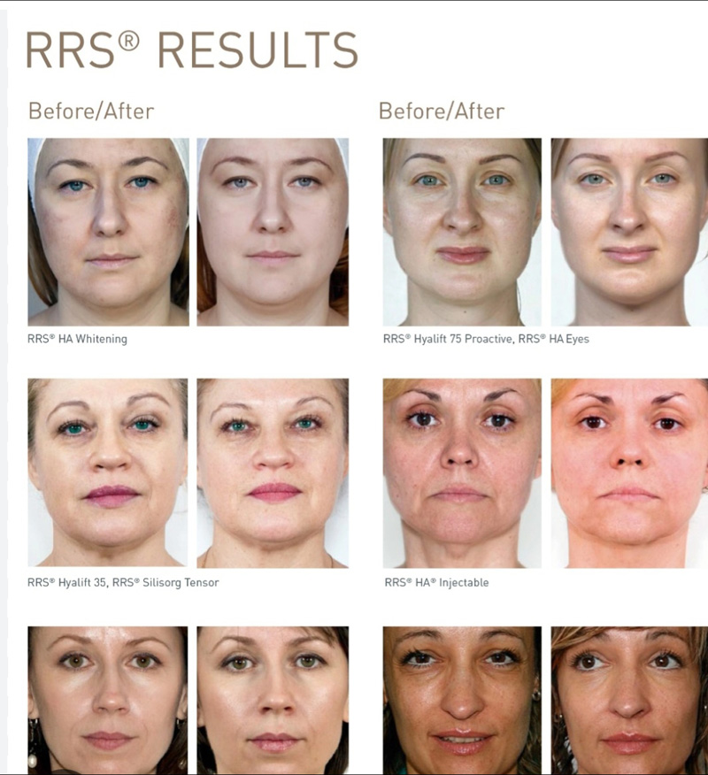 Rrs Results