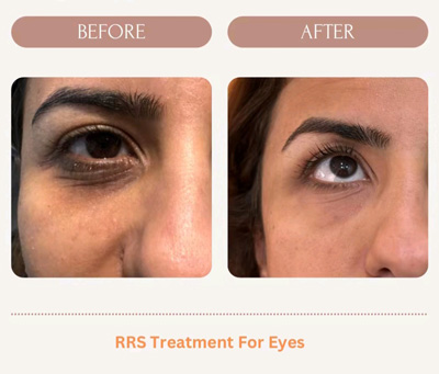 Rrs Treatment Eye Before And After